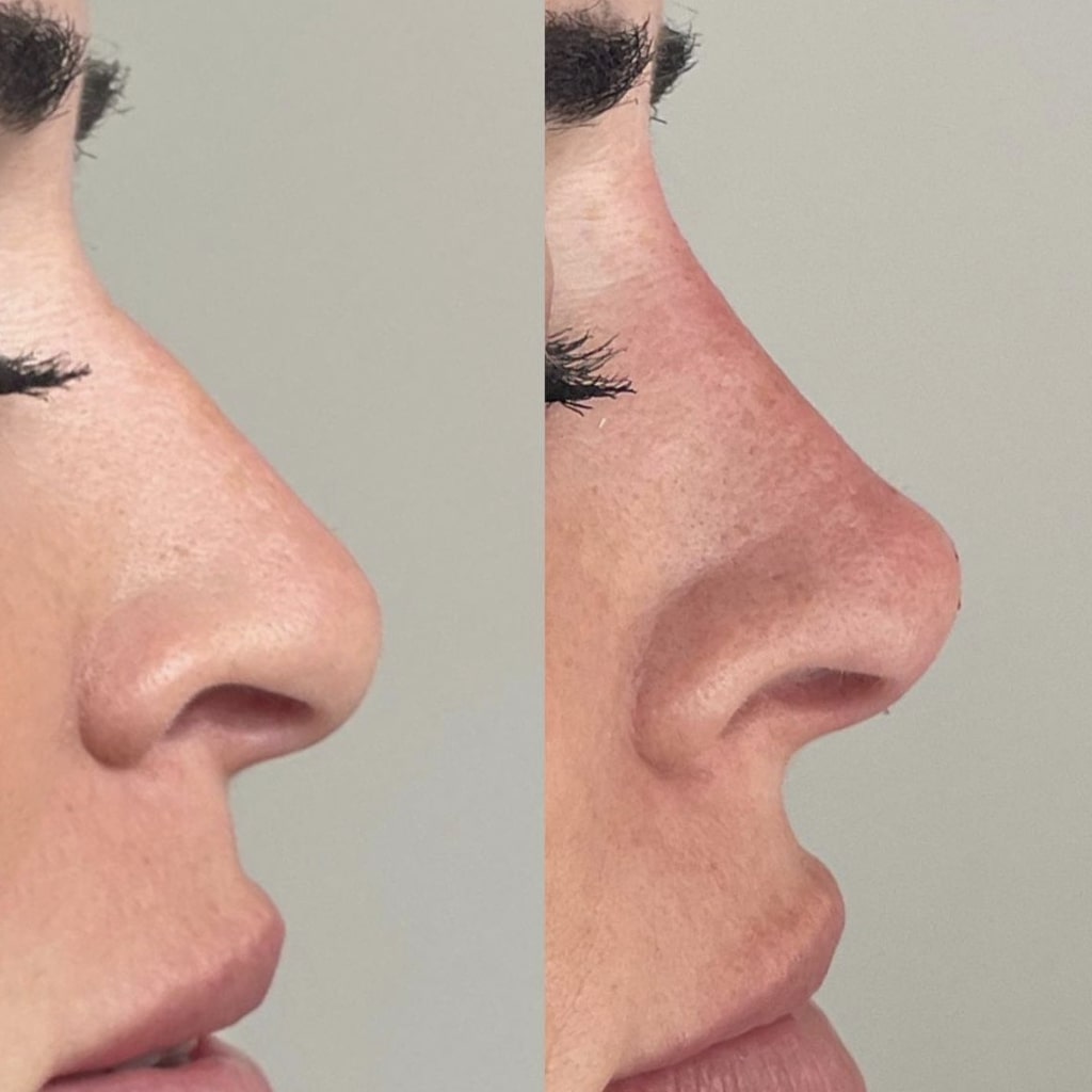 non surgical nose job before and after shot